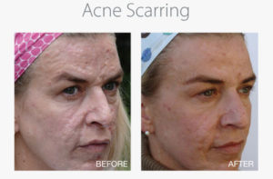 acne-scarring