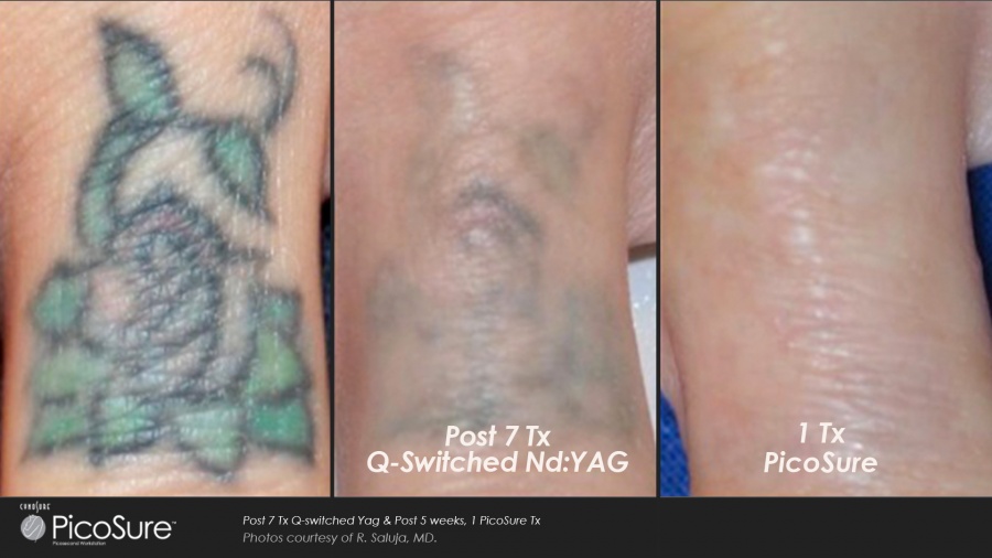 Picosure Laser for faster tattoo removal The Aesthetic 