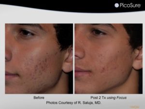 Picosure SkinRevit acne scar