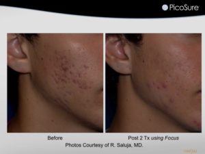 Picosure SkinRevit Acne scar