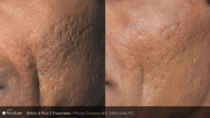 Picosure SkinRevit Acne scar