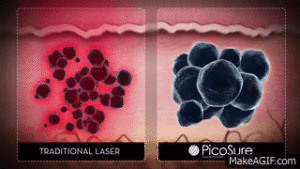 Picosure laser