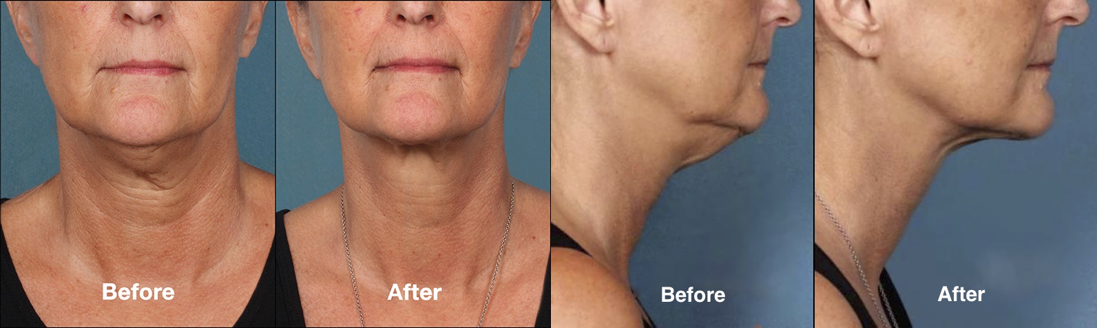 Body Contouring Near Me  Remove Chin Fat, Double Chin — Lazaderm Laser &  Aesthetics