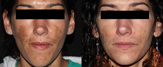 ba-picosure-lespinoza-post4tx-1-crop-u7391