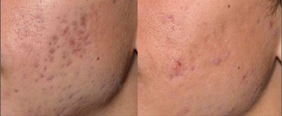 ba-picosure-r-saluja-acne-post4tx-011-crop-u7417