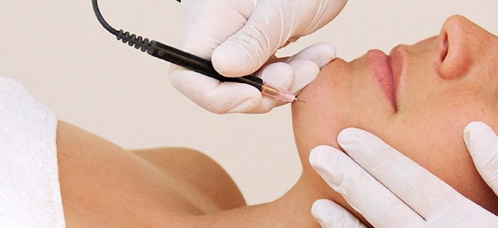 electrolysis-hair-removal