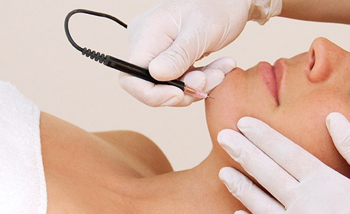 Permanent Electrolysis Hair Removal The Aesthetic Laser Centre